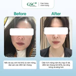 Kem Nám Tàn Nhang Hàn Quốc GSC Alpha Arbutin Ultra Cream 15g – Kem Hỗ Trợ Làm Mờ Và Ngăn Ngừa Thâm Nám - GC090A — ảnh 5