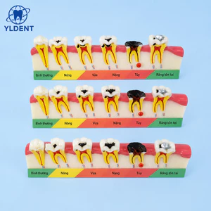 YLDENT Hàm tư vấn bệnh lý nha chu - Mô hình bệnh nha chu nha khoa 5 giai đoạn (XUẤT VAT)