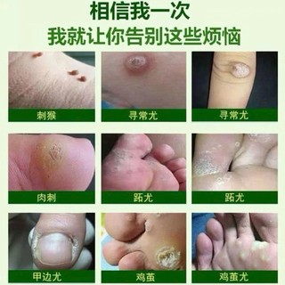 Kem Mụn Cóc Mụn Thịt Nhật Bản Hỗ Trợ Chăm Sóc Da Thừa Mụn Cóc Dạng Sợi, Giúp Da Mịn Màng Hơn 20g