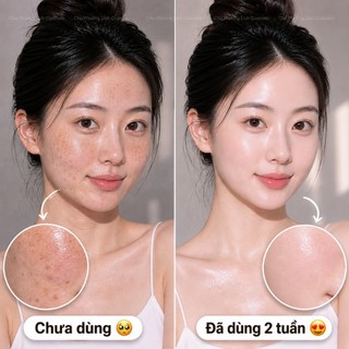 Combo Serum + Kem Nám Ruee Ver2 CB0318 – Xóa Mờ Nám, Tàn Nhang, Phục Hồi, Dưỡng Trắng Da Chuyên Sâu