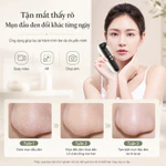 Máy hút mụn đầu đen kết nối camera trên điện thoại, loại bỏ mụn đầu đen và sợi bã nhờn nhanh chóng CSSD9 OLIVIA — ảnh 2