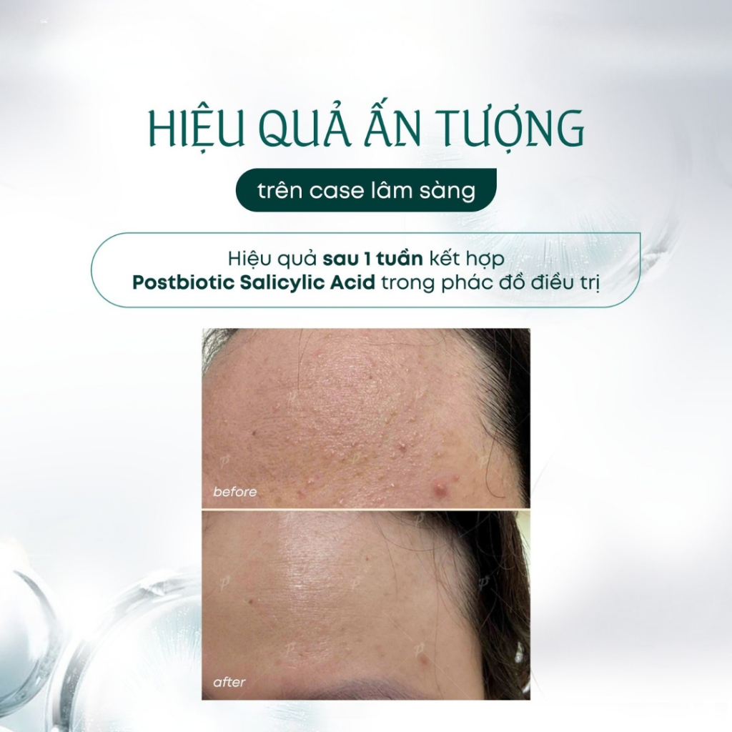 [Công Ty] ATACHE Oily SK Postbiotic Salicylic Acid Serum  Dành Cho Da Dầu 30ml | BigBuy360 - bigbuy360.vn
