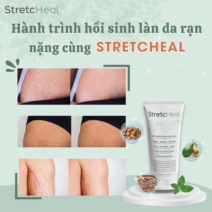KEM NGỪA RẠN DA STRECHEAL DƯỠNG ẨM HỖ TRỢ GIẢM RẠN DA CHO MẸ BẦU VÀ SAU SINH