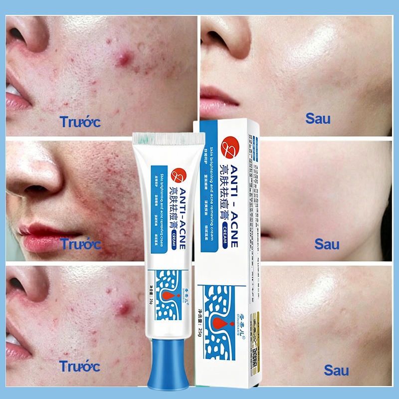 Kem chấm mụn 2 trong 1 giảm sưng đỏ thâm mụn, kháng khuẩn, làm sạch da cho mụn tuổi dậy thì