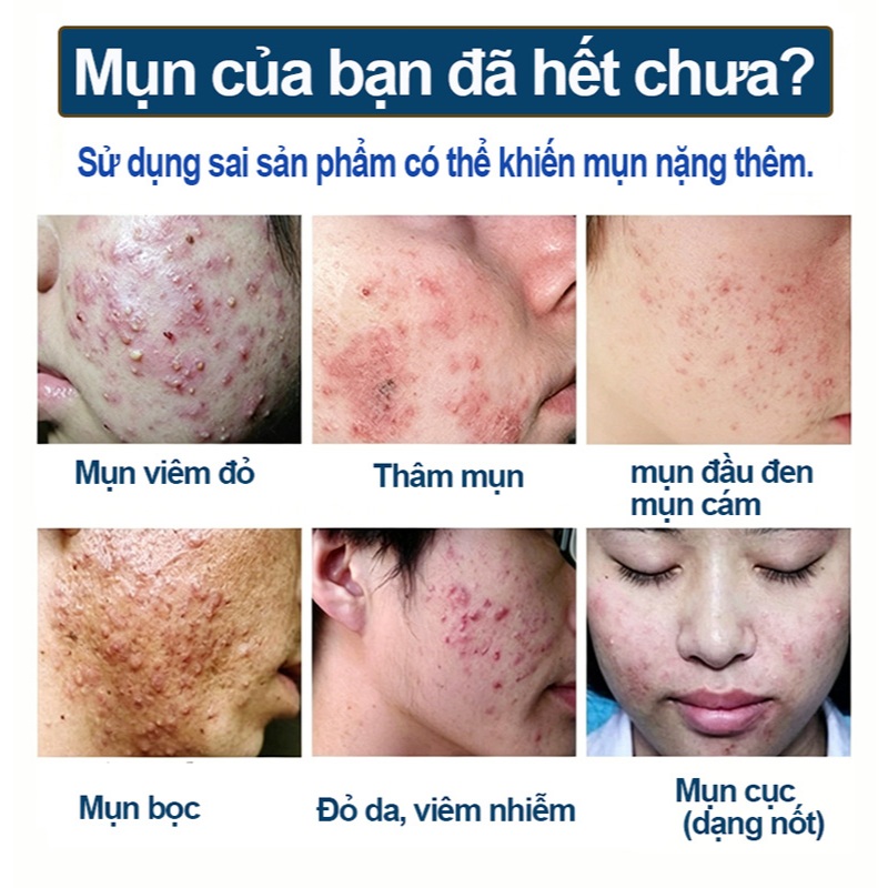 Kem chấm mụn 2 trong 1 giảm sưng đỏ thâm mụn, kháng khuẩn, làm sạch da cho mụn tuổi dậy thì