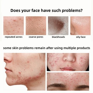 Kem chấm mụn cấp tốc loại bỏ các loại mụn, mụn đầu đen,mụn ở tuổi dậy thì,loại bỏ mụn bọc cho da dầu
