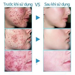 Kem chấm mụn cấp tốc loại bỏ các loại mụn, mụn đầu đen,mụn ở tuổi dậy thì,loại bỏ mụn bọc cho da dầu