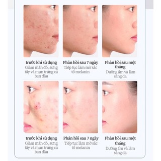 Kem chấm mụn cấp tốc loại bỏ các loại mụn, mụn đầu đen,mụn ở tuổi dậy thì,loại bỏ mụn bọc cho da dầu