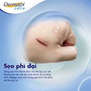 Gel Dermatix Ultra 15g - Dematix Gel giảm sẹo lồi, phẫu thuật sẹo sau sinh an toàn cho mẹ và bé