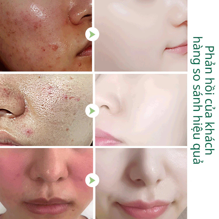【CấP ẨM Sâu】 Mặt nạ bong bóng Anthocyanin Dưưỡng Da Không Khô Rát sạch sâu Kiểm soát dầu dưỡng ẩm B3