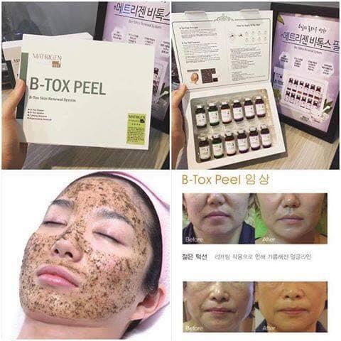 ULTRA V PEEL, BTOX PEEL 2 MÀU, BTOX PEEL 4 MÀU, THAY DA SINH HỌC, GIẢM MỤN, THÂM NÁM