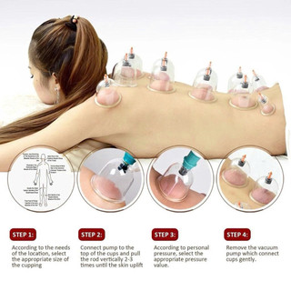 BỘ GIÁC HƠI 12 ỐNG HÚT CHÂN KHÔNG KHÔNG DÙNG LỬA