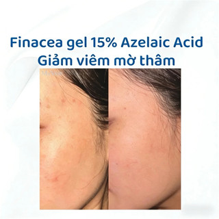 Gel Finacea 15% Azelaic Acid 30g