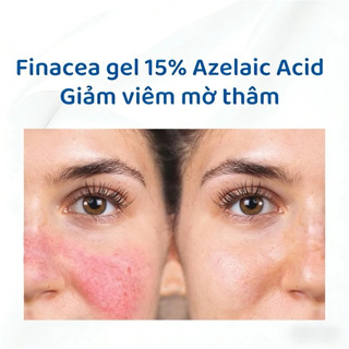 Gel Finacea 15% Azelaic Acid 30g