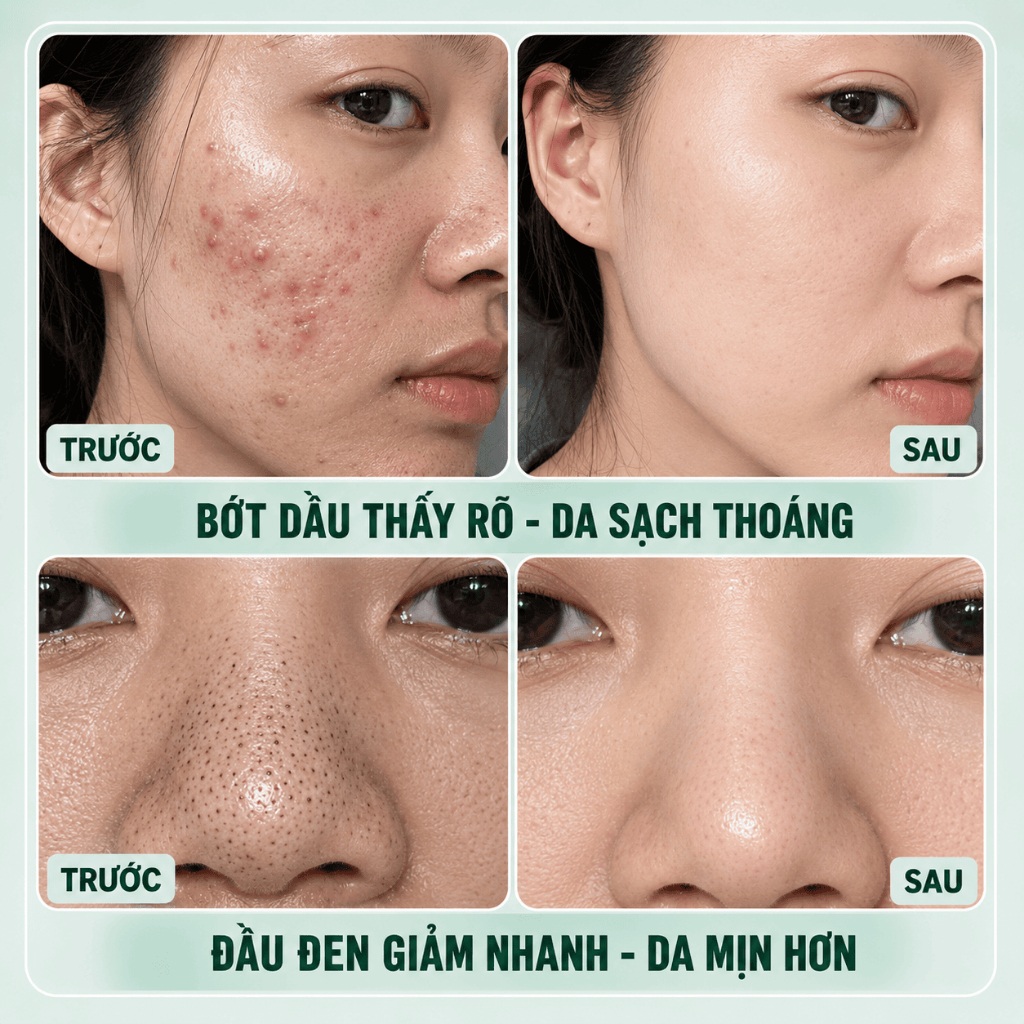 LYDIMOON Mặt nạ đất sét axit salicylic 100g, loại bỏ mụn đầu đen kiềm dầu sạch mụn dưỡng trắng sáng da