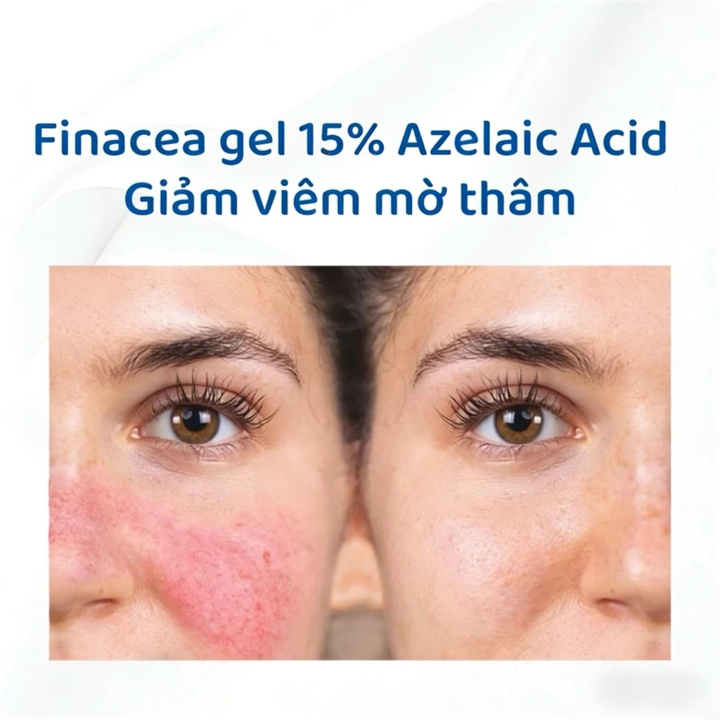Gel Finacea Azelaic Acid 15% 30g Hàng Úc