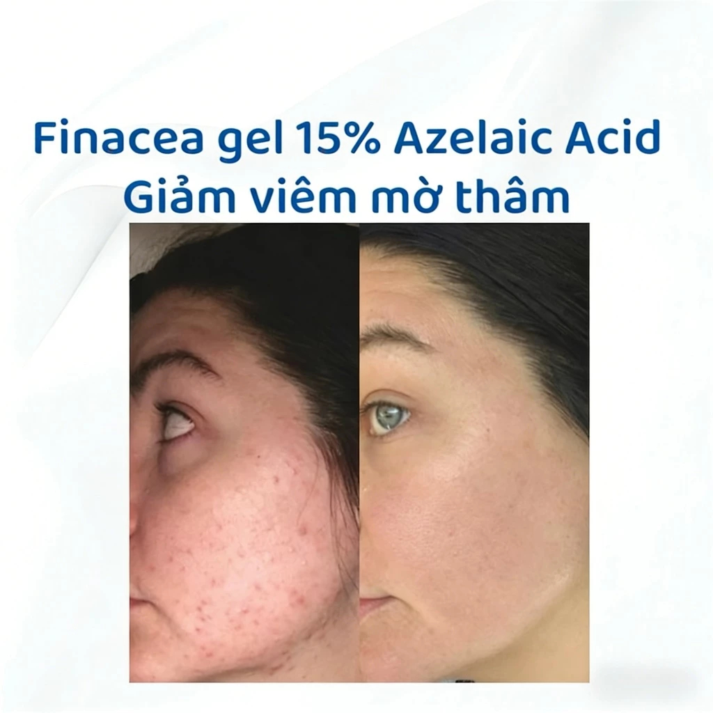 Gel Finacea Azelaic Acid 15% 30g Hàng Úc