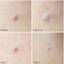 Miếng Dán Mụn Olive Young Care Plus Scar Cover Spot Patch