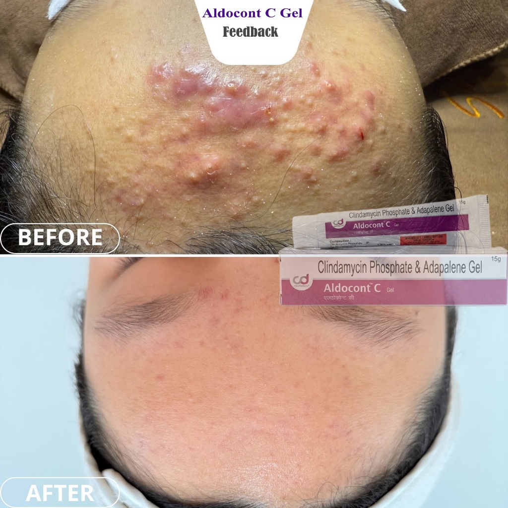 Gel Mụn Aldocont C Gel Hỗ Trợ Làm Giảm Mụn Cám Và Ngăn Ngừa Mụn Trứng Cá An Toàn (15g)