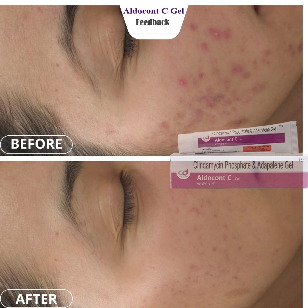 Mụn Aldocont C Adapalene Gel Giảm Mụn Bọc Mụn Viêm Dành Cho Da Nhạy Cảm Gel 15g