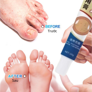 Kem Bôi Đánh Bay Mụn Cóc, Mụn Thịt Nấm Ngứa Chân Tay