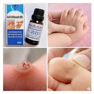 Chấm mụn cóc, mụn cơm, mụn thịt, suimaoga