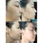 Kem mờ thâm nám,Fading Melasma Cream cao cấp, mờ nám, tàn nhang, vết thâm