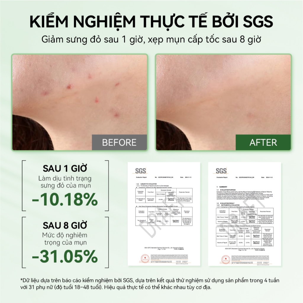 LANBENA Chấm Mụn  (12ml) - Hỗ Trợ Giảm Mụn, Xẹp Mụn Trứng cá/Mụn Mủ/Mụn Nhọt Hiệu Quả   Skincare