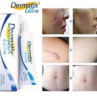Gel bôi sẹo Dermatix ultra 7g