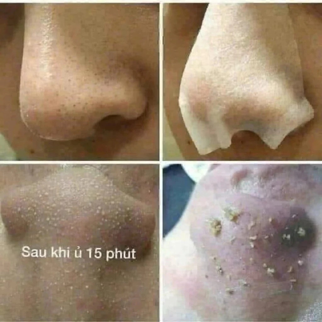 Tinh chất ủ mụn đầu đen Medipeel Blackhead Care Solution Extra