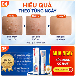 Kem bôi loại bỏ mụn thịt, mụn nhỏ ở cổ, mụn cóc, nách – Dưỡng da làm đẹp.