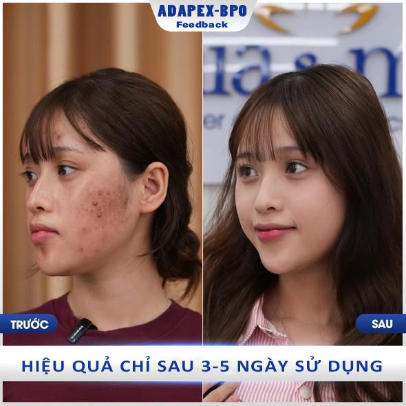 Kem Bôi Mụn Adapex BPO Gel 20g – Gel Giảm Mụn Dưỡng Da Kết Cấu Trong Suốt Cân Bằng Dầu & Dưỡng Ẩm