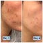 Sữa rửa mặt giảm mụn Panoxyl Creamy Acne Wash 4% 170g- Foaming Acne Wash 10% Benzoyl Peroxide