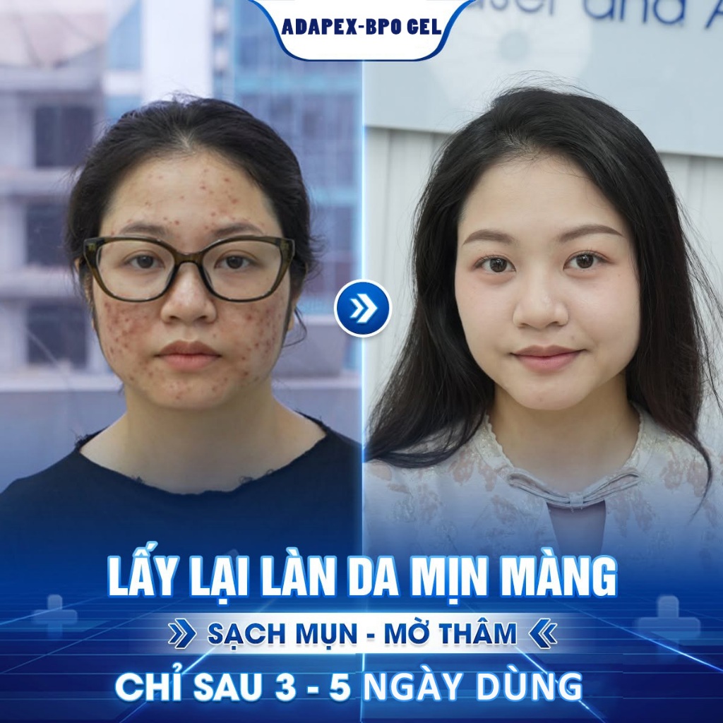 Kem Giảm Mụn Benzoyl Adapex BPO Adapalene Gel Giảm Mụn Bọc Mụn Viêm Dành Cho Da Nhạy Cảm Gel 20g