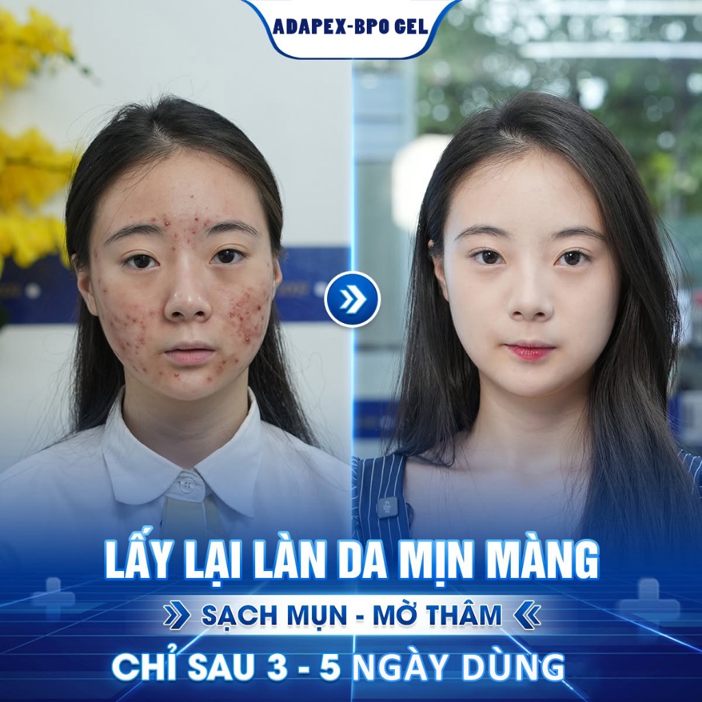 Kem Bôi Mụn Adapex BPO Gel 20g – Gel Giảm Mụn Dưỡng Da Kết Cấu Trong Suốt Cân Bằng Dầu & Dưỡng Ẩm
