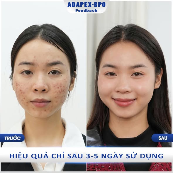 Kem Bôi Mụn Adapex BPO Gel 20g – Gel Giảm Mụn Dưỡng Da Kết Cấu Trong Suốt Cân Bằng Dầu & Dưỡng Ẩm