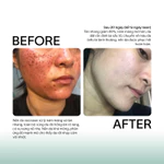 Tế Bào Gốc Chống Lão Hóa, Xử Lý Sẹo Rỗ GSC Anti Ageing Ampoule Tăng Sinh Collagen, Phục Hồi Da Peel 10ml - GB023A — ảnh 5