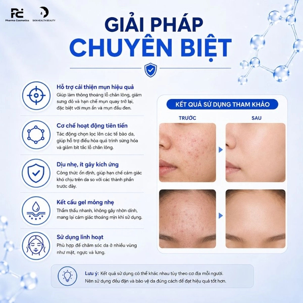 Kem Chấm Mụn Adapalene Gel USP 0,1% w/w 30g Hỗ Trợ Giảm Mụn Ẩn Mụn Đầu Đen, Mụn Mủ, Mụn Bọc Hiệu Quả