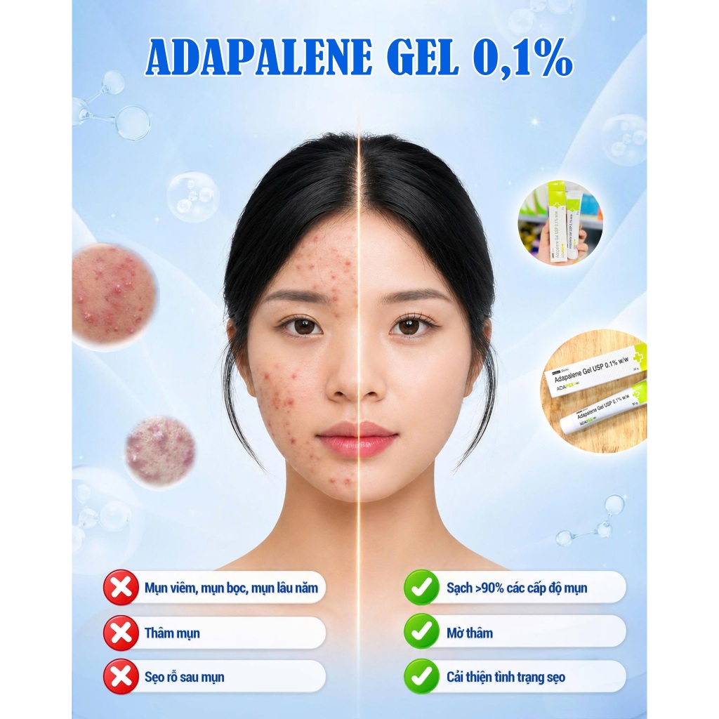 Kem Chấm Mụn Adapalene Gel USP 0,1% w/w 30g Hỗ Trợ Giảm Mụn Ẩn Mụn Đầu Đen, Mụn Mủ, Mụn Bọc Hiệu Quả