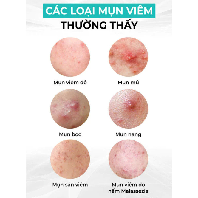 Kem Benzac AC 15g - Hỗ trợ làm sạch da, giảm mụn nhẹ, làm dịu da và phù hợp da nhạy cảm | BigBuy360 - bigbuy360.vn