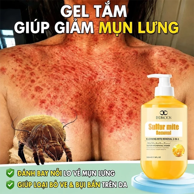 Sữa tắm mụn lưng Sữa tắm lưu huỳnh sữa tắm trắng 500ml Loại bỏ mụn trứng cá và ve ngứa Làm mới kiểm soát dầu