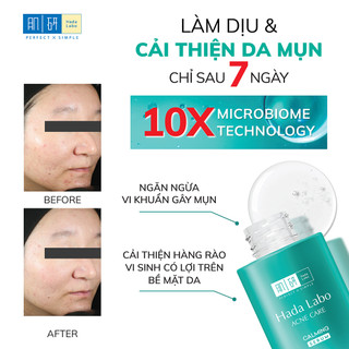 [KOL] Serum hỗ trợ dưỡng ẩm cho da mụn, nhạy cảm Hada Labo Acne Care Calming 30ml