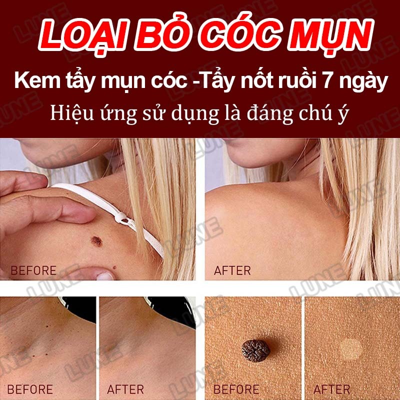Bút Tẩy Nốt Ruồi, Xóa Mụn Thịt, Tẩy Mụn Cóc, Kem tẩy mụn cóc Tẩy nốt ruồi 7 ngày, không đau rát, thành phần thiên