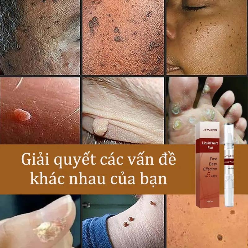Bút Tẩy Nốt Ruồi, Xóa Mụn Thịt, Tẩy Mụn Cóc, Kem tẩy mụn cóc Tẩy nốt ruồi 7 ngày, không đau rát, thành phần thiên