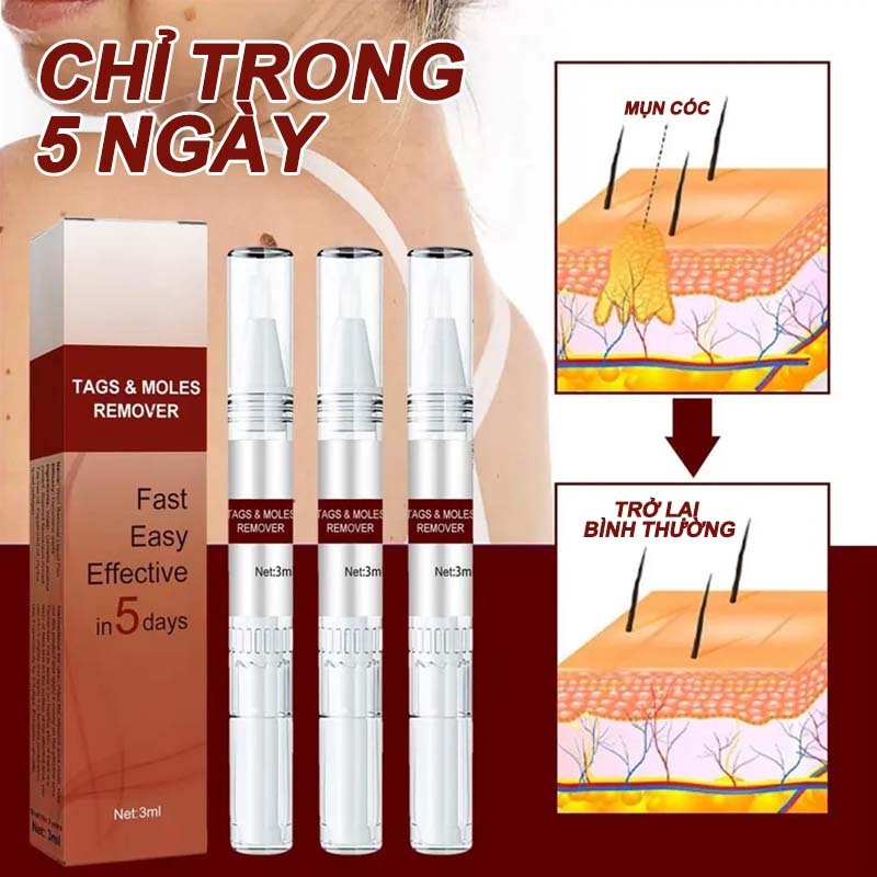 Bút Tẩy Nốt Ruồi, Xóa Mụn Thịt, Tẩy Mụn Cóc, Kem tẩy mụn cóc Tẩy nốt ruồi 7 ngày, không đau rát, thành phần thiên