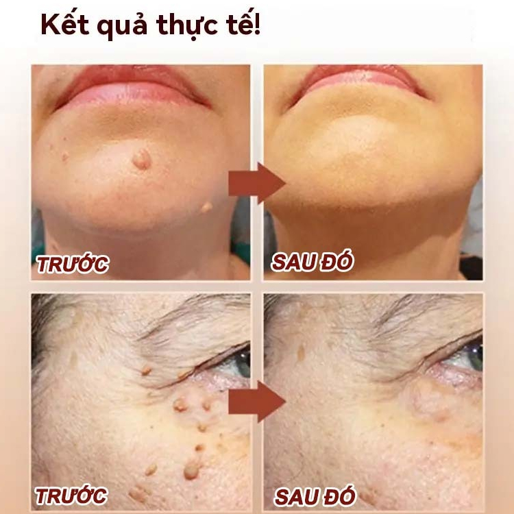 Bút Tẩy Nốt Ruồi, Xóa Mụn Thịt, Tẩy Mụn Cóc, Kem tẩy mụn cóc Tẩy nốt ruồi 7 ngày, không đau rát, thành phần thiên