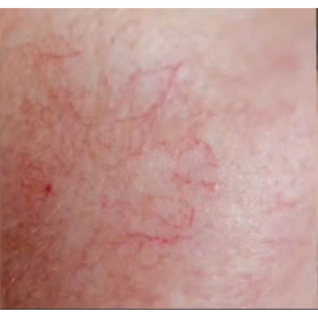 Chính Hãng Kem Phục Hồi Da Mộc Nhân Sau Peel Mỏng Yếu Lộ Mao Mạch Dể kích Ứng Mẩn Đỏ