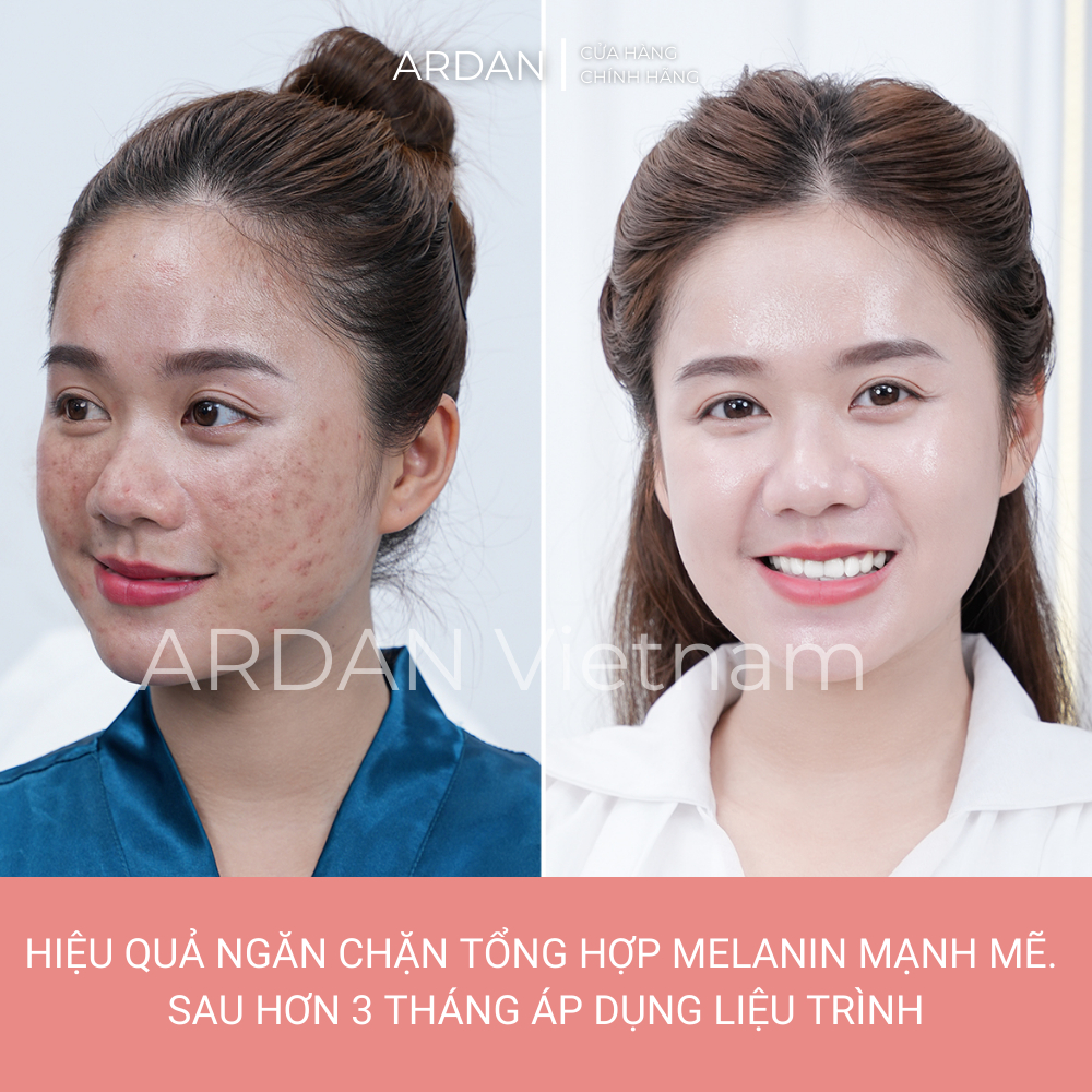 Serum Nám Da Tàn Nhang ARDAN 20ml - Hiệu Quả Mờ Nám Tàn Nhang Nhanh Chóng