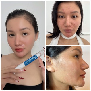 Retinol Mix Peel Mocha Peel Da Cải Thiện Mụn, Nám, Làm Đẹp Skincare Tại Nhà Mua 1 Tặng 2
