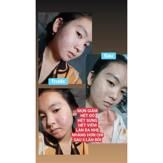 GEL    MỤN